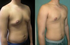 Vú to ở nam giới có phải là bệnh? Có nguy hiểm không?