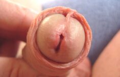 Nguyên nhân viêm niệu đạo là gì? Có nguy hiểm không?