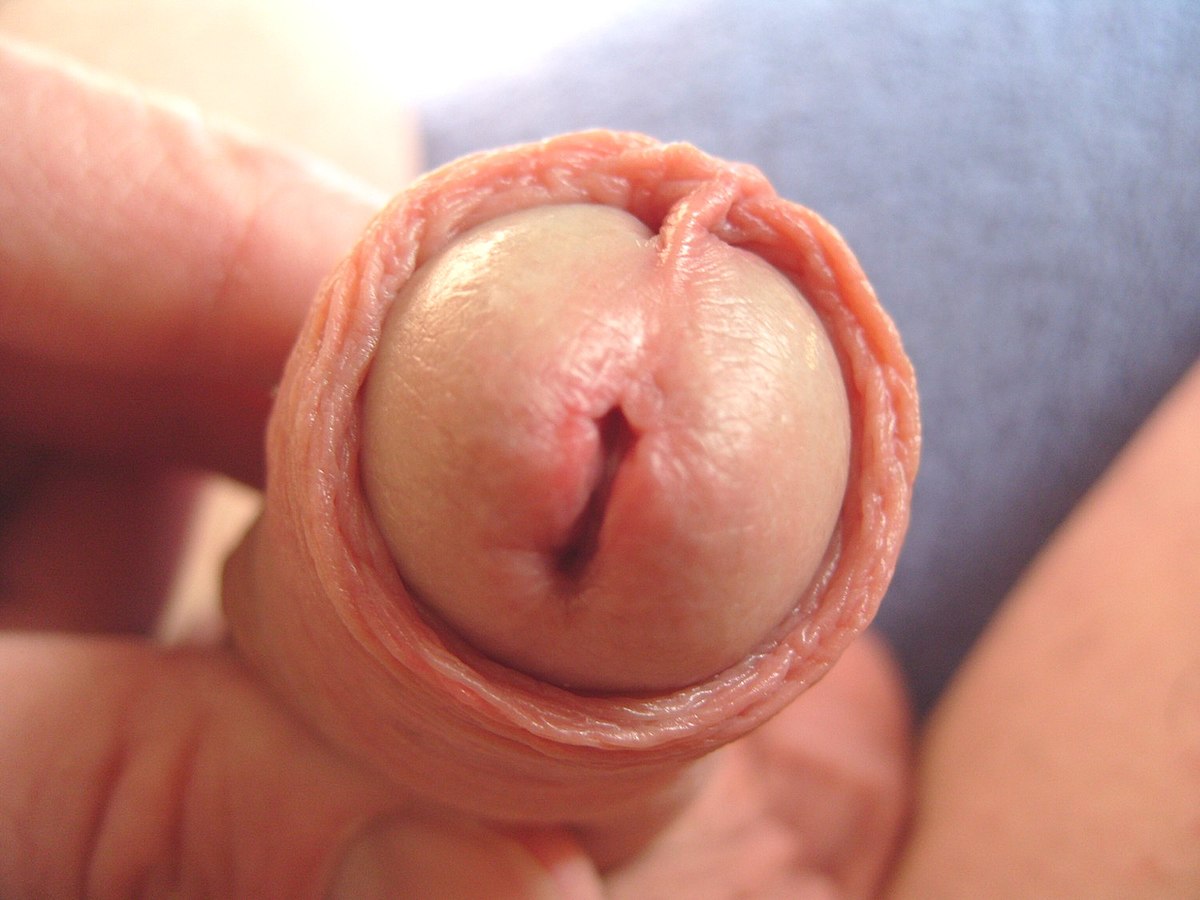 Nguyên nhân viêm niệu đạo là gì? Có nguy hiểm không?