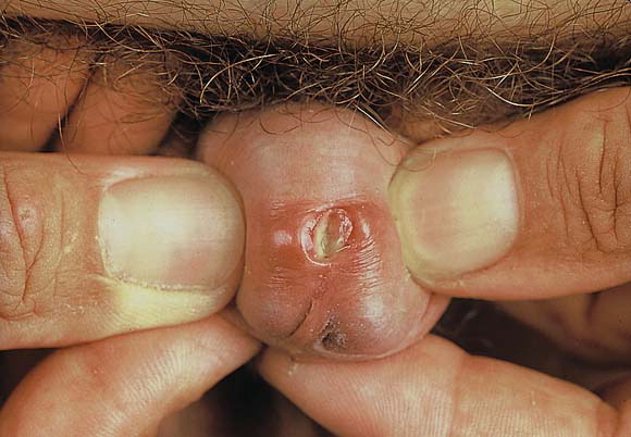 Tác hại của bệnh viêm niệu đạo ở nam giới