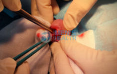 Đối Sùi Mào Gà Có Phải Phương Pháp Điều Trị Dứt Điểm