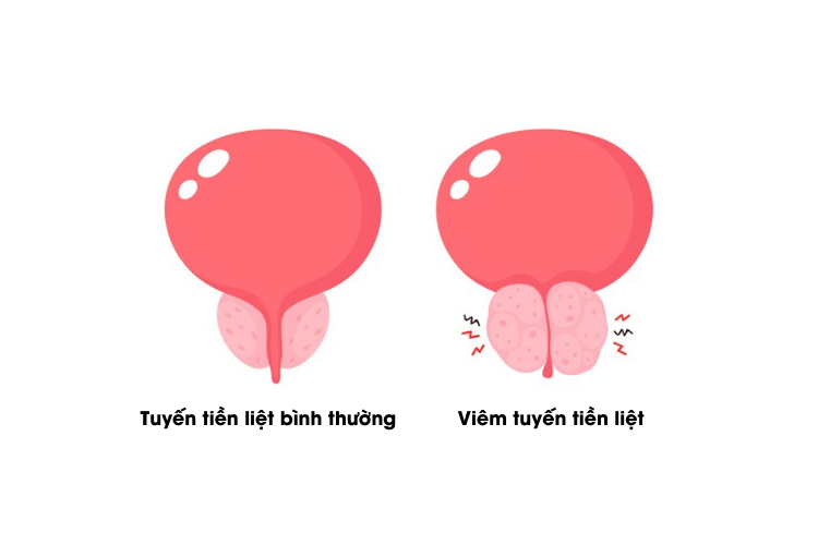Quá trình viêm tuyến tiền liệt do nhiễm khuẩn có thể hình thành các áp xe tuyến tiền liệt