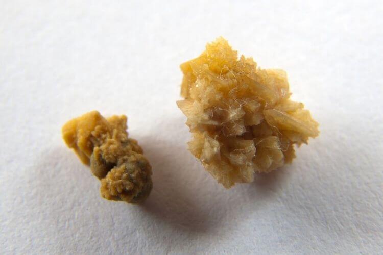 phân loại sỏi tiết niệu