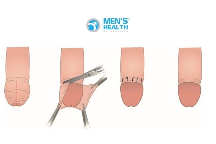 Cắt bao quy đầu bằng phương pháp vi phẫu thẩm mỹ cao, không để lại sẹo xấu