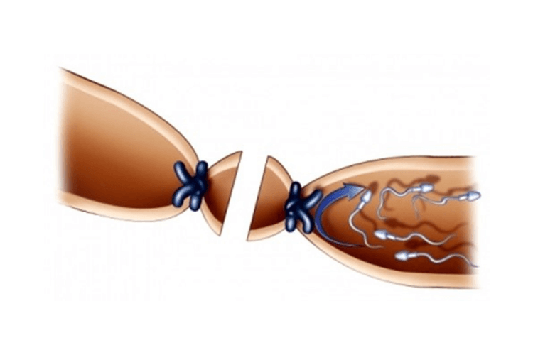 phẫu thuật thắt ống dẫn tinh ở nam giới