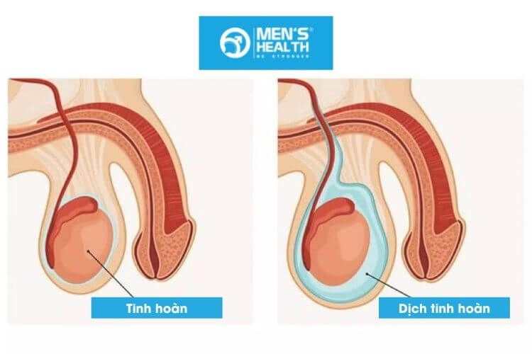 tràn dịch tinh hoàn