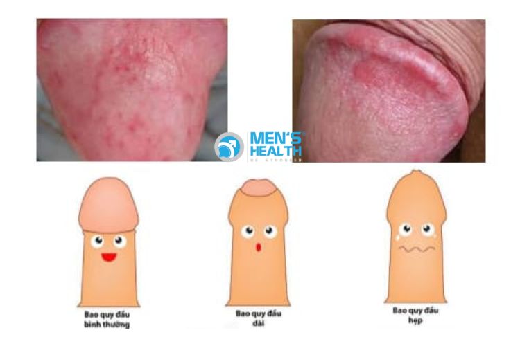 Bao quy đầu dài, hẹp làm khó vệ sinh và dễ gây bựa sinh học ở nam giới