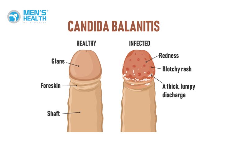 Môi trường axit mất cân bằng độ pH ở vùng kín sẽ tạo điều kiện cho nấm phát triển, gây nên tình trạng viêm nhiễm bao quy đầu-quy đầu.