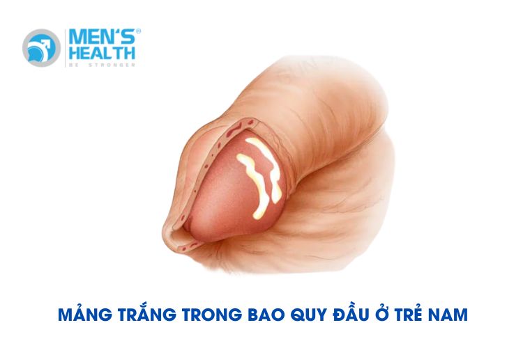 Chất bã tích tụ do tế bào da chết, dịch tiết từ các tuyến bã, chất nhờn tạo thành bựa sinh dục