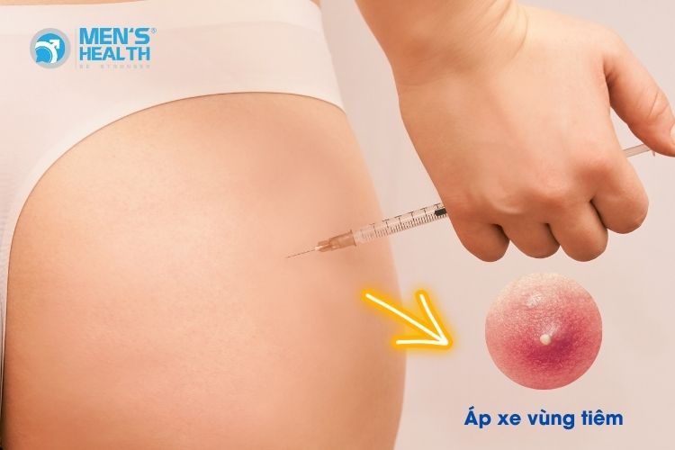 Biến chứng áp xe vùng tiêm có thể xảy ra khi tiêm hormone