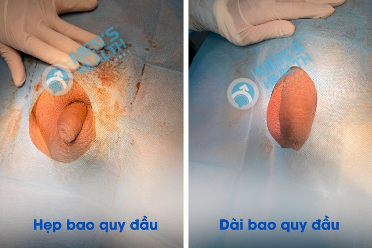 Hình ảnh bao quy đầu hẹp/dài của bệnh nhân trước khi phẫu thuật gây nhiều bất tiện trong sinh hoạt