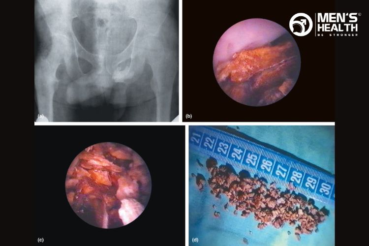 Sỏi tuyến tiền liệt (vôi hóa tuyến tiền liệt) sau khi phẫu thuật loại bỏ