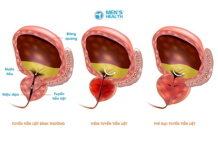 Vôi hóa tuyến tiền liệt có thể liên quan tới các căn bệnh như phì đại tuyến tiền liệt, viêm tuyến tiền liệt