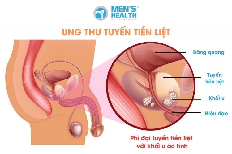 Vôi hóa tuyến tiền liệt có thể dẫn đến ung thư tuyến tiền liệt nếu không được chữa trị kịp thời