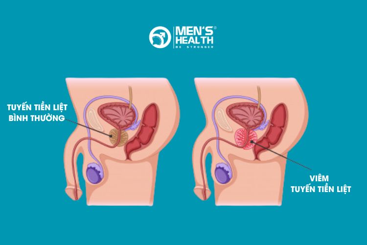  Các nghiên cứu cho thấy 77% người bệnh phì đại lành tính tuyến tiền liệt bị viêm tuyến tiền liệt mạn tính 
