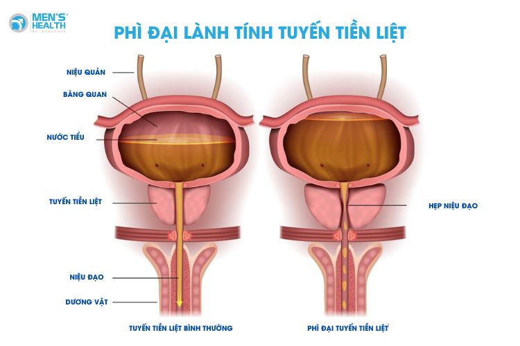Phì đại lành tính tuyến tiền liệt cũng liên quan với tiểu đêm