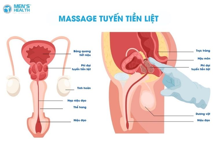 Điều trị triệu chứng viêm tuyến tiền liệt hỗ trợ bằng mát-xa tuyến tiền liệt có thể áp dụng khi cần thiết
