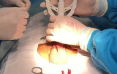 Có nên cắt bao quy đầu bằng máy không? Phương pháp cắt nào tốt nhất?