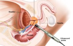 Understanding the Purpose of a Prostate Biopsy