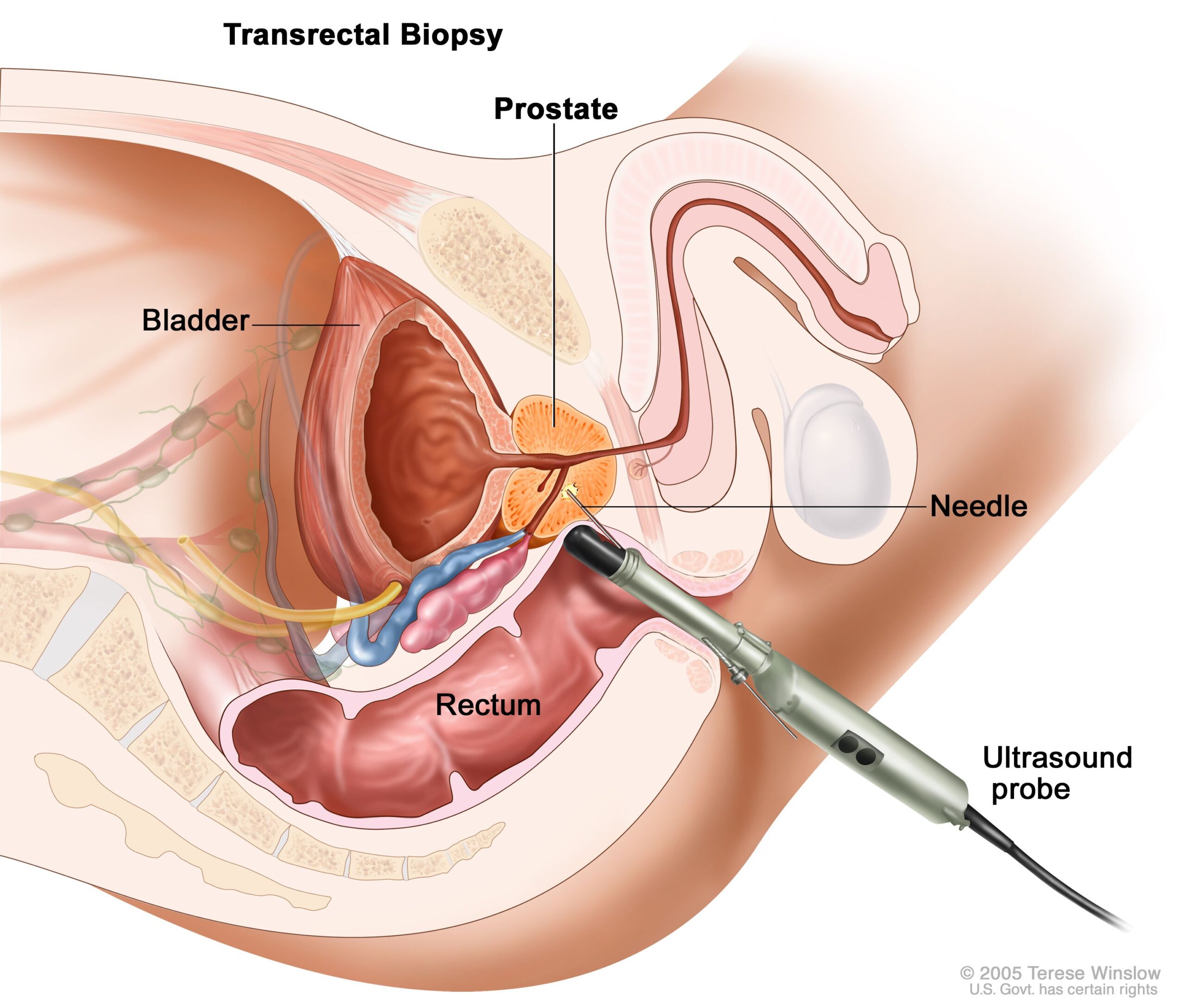 Understanding the Purpose of a Prostate Biopsy